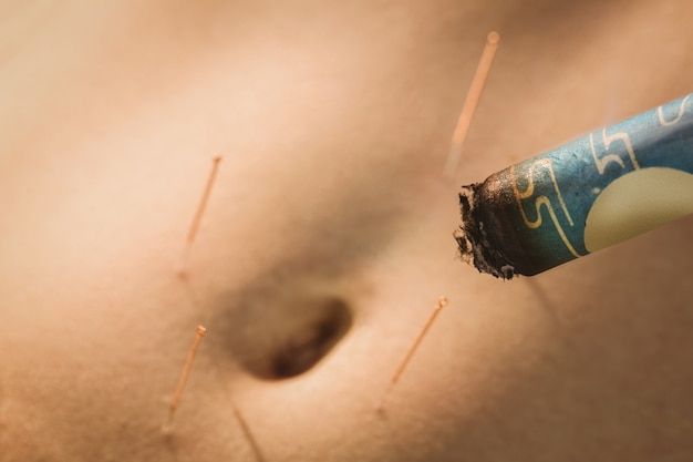 Close-up of acupuncture needles inserted into skin, with a burning moxa stick partially in view.